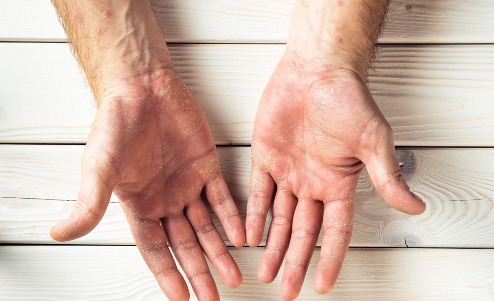 מחלות-אוטואימוניות דלית דרימן